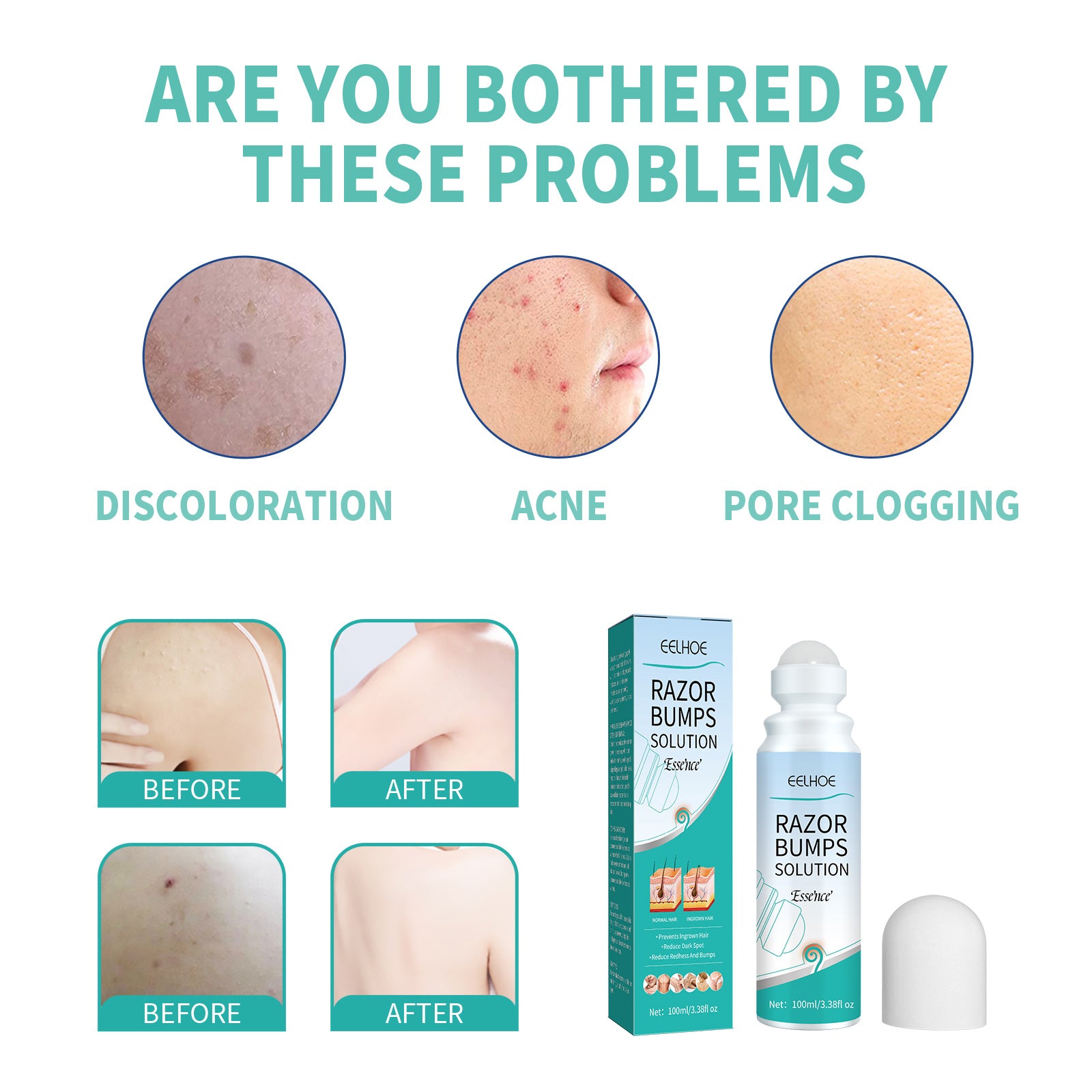 EELHOE Shaving Lump Repair Roll Essence, Prevent Ingrown Hair, Repair Skin Bumps